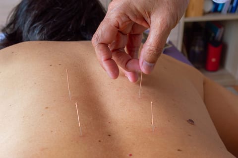 Quais os benefícios da acupuntura